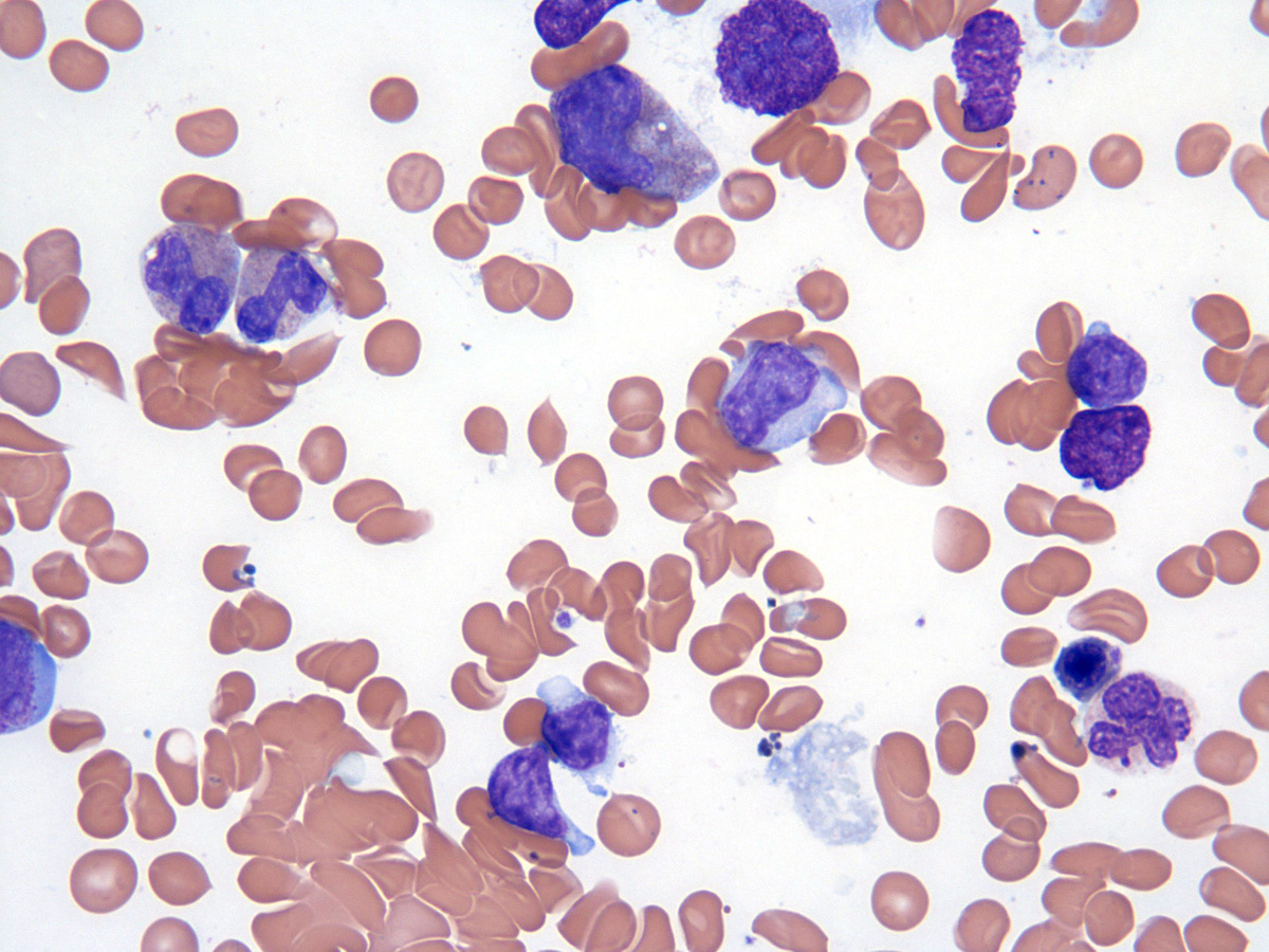 Bone Marrow aspirate_1